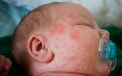 Những điều cần biết khi chăm sóc bệnh nhân sốt xuất huyết tại nhà