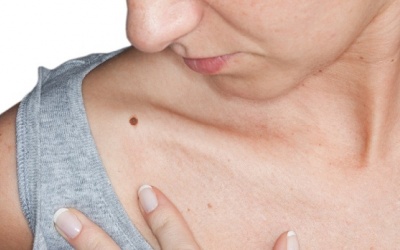 Mối liên hệ giữa bệnh Parkinson và bệnh ung thư da