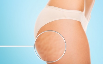 6 tư thế yoga giúp làm giảm tình trạng da sần vỏ cam cellulite
