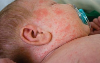 Tại sao lượng tiểu cầu vẫn thấp sau khi khỏi sốt xuất huyết?