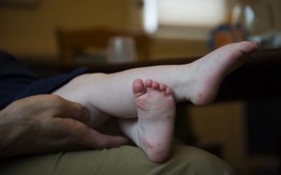 5 điều cần biết về bệnh tay chân miệng