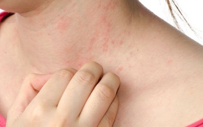 Nên làm gì khi bị viêm da cơ địa để bệnh không nặng lên?