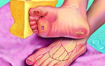 Nguyên nhân nào khiến người đái tháo đường bị hoại tử, cắt cụt chân?