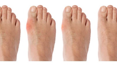 Chỉ số acid uric 8,5mg/dL đã mắc bệnh gout chưa?