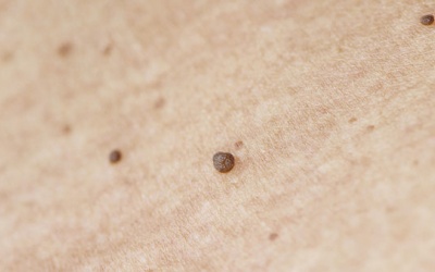 Cách trị mụn thịt ở cổ tại nhà với giấm và tinh dầu