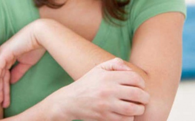 Nổi mề đay khi điều trị tuyến giáp có nên dùng TPCN Ích Giáp Vương?