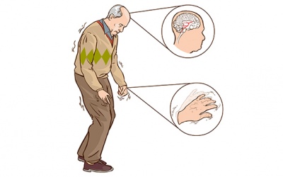 Nhận biết 9 dấu hiệu cảnh báo bệnh Parkinson