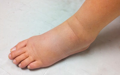 Những điều nên và không nên làm khi cơ thể bị giữ nước hay phù nề