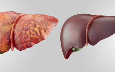 6 bước thải độc gan, làm sạch gan trong vài tuần