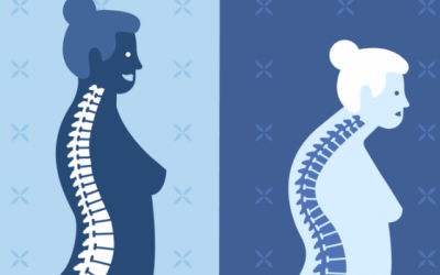 Bạn bị loãng xương: Áp dụng ngay 5 cách này!