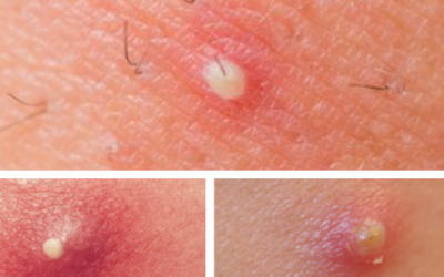 Mọc nhiều mụn nhọt ở đùi và mông là bị làm sao?