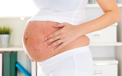 Triệu chứng vẩy nến ở phụ nữ có thể thay đổi do hormone? 