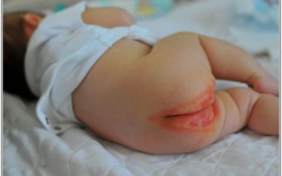 Hăm tã và cách điều trị đơn giản tại nhà