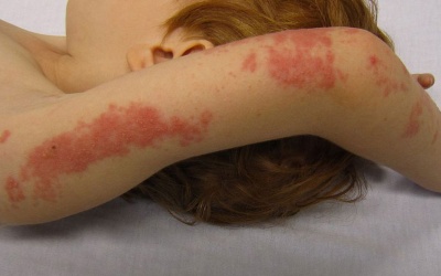 Dùng Subạc có làm lành vết loét ngoài da do zona thần kinh?