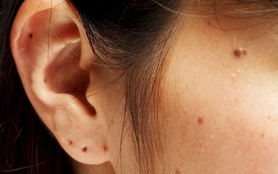 Mọc nốt ruồi có lông ở dưới cánh mũi, có tẩy được không?