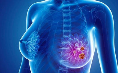 8 bệnh viện Việt Nam tầm soát ung thư vú miễn phí cho phụ nữ từ 40 tuổi