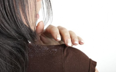 Mẹo hay trị gàu đơn giản ngay tại nhà