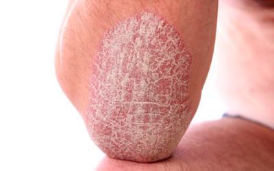 Bị bệnh vẩy nến: Nhớ dùng nước cốt dừa