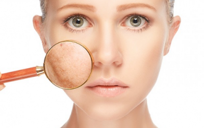 Mới 20 tuổi đã bị nám da, sạm da: Cách chữa thế nào?