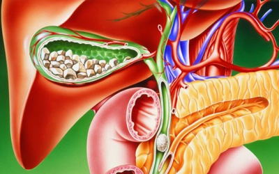 Chuyên gia chia sẻ: Những điều bạn cần biết về sỏi mật