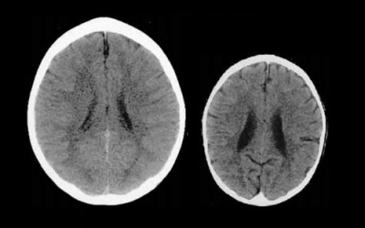 Cảm xúc tiêu cực ảnh hưởng đến phát triển trí não trẻ như thế nào?