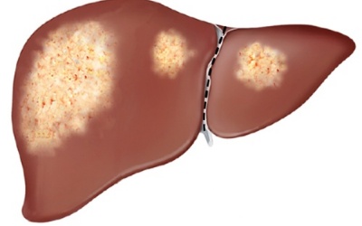 Ăn gì để điều trị bệnh gan nhiễm mỡ?
