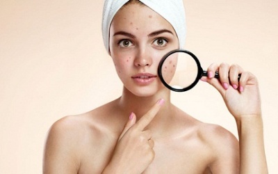 Ăn gì giúp bạn đối phó với mụn trứng cá?