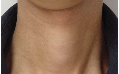 Nổi u ở cổ có phải bị bướu cổ không? 