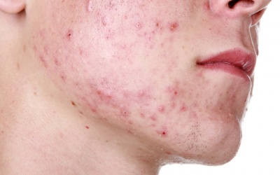 Nổi mụn trứng cá nhiều trên mặt, điều trị laser có khỏi hẳn không?