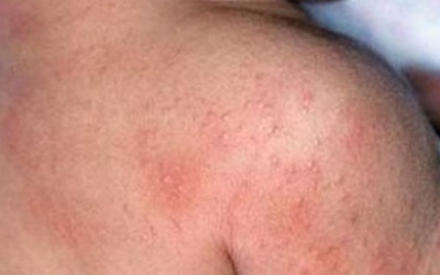 Bị ngứa, nổi mẩn, có nên dùng Eczestop?