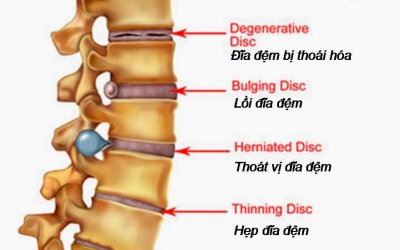 Bị thoát vị địa đệm cần ăn uống và tập luyện thế nào để điều trị bệnh?