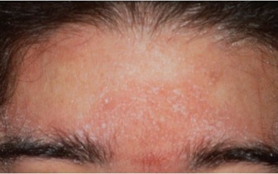 Bị viêm da tiết bã nhờn, cần bổ sung dinh dưỡng như thế nào?