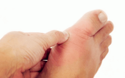 Ngón chân cái bị đau nhức, sưng đỏ có phải bị gout không?