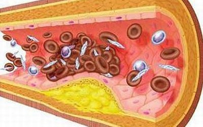 Bị mỡ máu cao, uống thực phẩm chức năng có giúp giảm mỡ máu không?