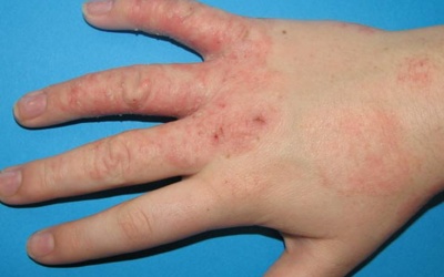 Da tay bị bong tróc, bên trong chứa nước là bị bệnh gì?