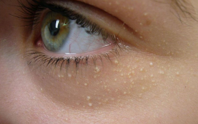 Cách hỗ trợ điều trị và làm mờ mụn thịt trên da ngay tại nhà