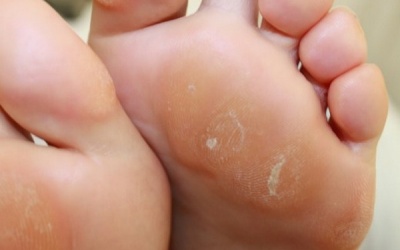 Làm giảm tình trạng chai chân ở thai phụ bằng cách nào?