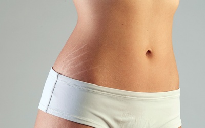 Rạn da là dấu hiệu bệnh tật nghiêm trọng?