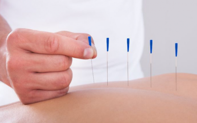 Châm cứu có giúp giảm đau lưng? 