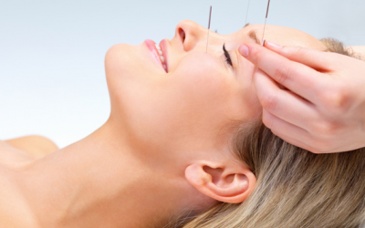 Châm cứu có giúp giảm đau đầu và đau nửa đầu? 