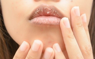 Môi khô, nứt nẻ và bong tróc vì nguyên nhân nào?