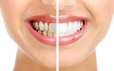 5 nguyên nhân phổ biến khiến răng bị đổi màu
