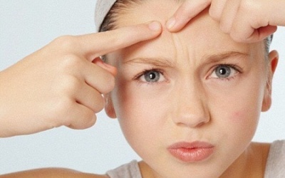 5 bước giúp con bạn đối phó với mụn trứng cá