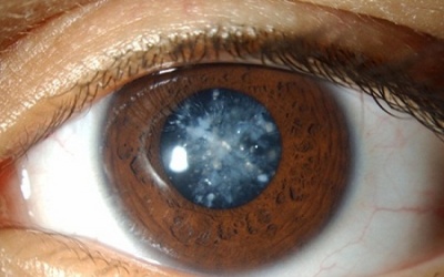 Dưỡng chất nào giúp ngăn ngừa đục thủy tinh thể?