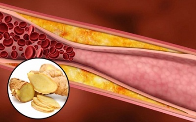 Gừng -  thảo mộc giúp loại bỏ mảng bám, ngăn ngừa xơ vữa động mạch