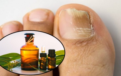 Tinh dầu bạch đàn - Phương pháp tự nhiên giúp trị nấm móng