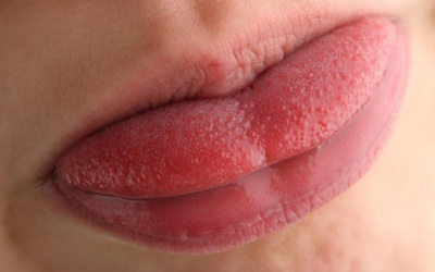 Nguyên nhân nào gây viêm, nhiệt lưỡi?