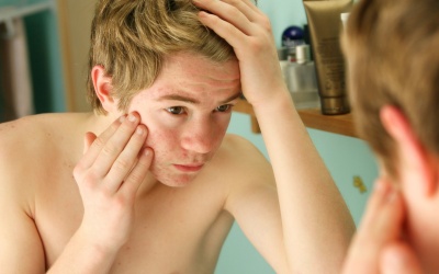 Cách trị hết mụn mà vẫn an toàn cho da?