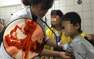 Bệnh nhi bị tan máu cấp nghi do ăn thịt bò khô không rõ nguồn gốc