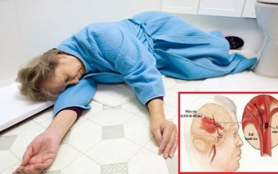 Đột quỵ - Phòng ngừa không khó!